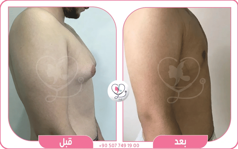 صورة لرجل أجرى عملية التثدي نتائج قبل وبعد