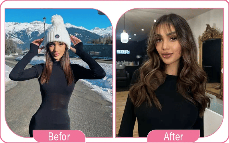 Le nez de Maissane est-il conséquence d'une rhinoplastie réussie ?