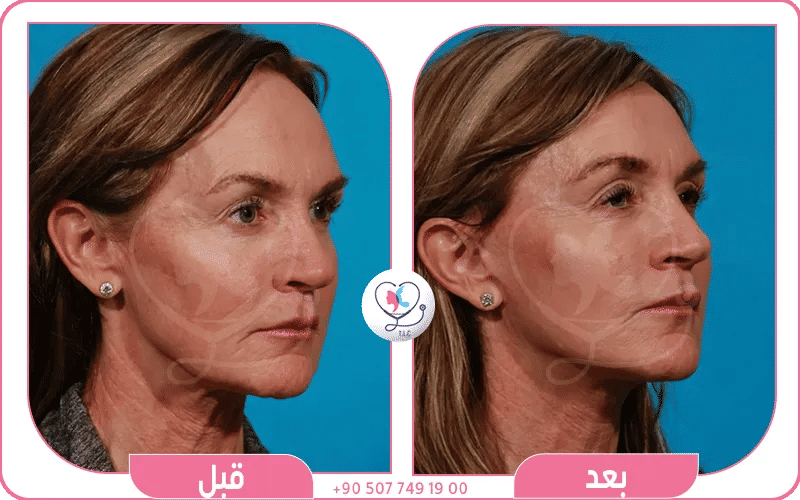 نتائج تجربتي مع عملية تصغير الجبهة