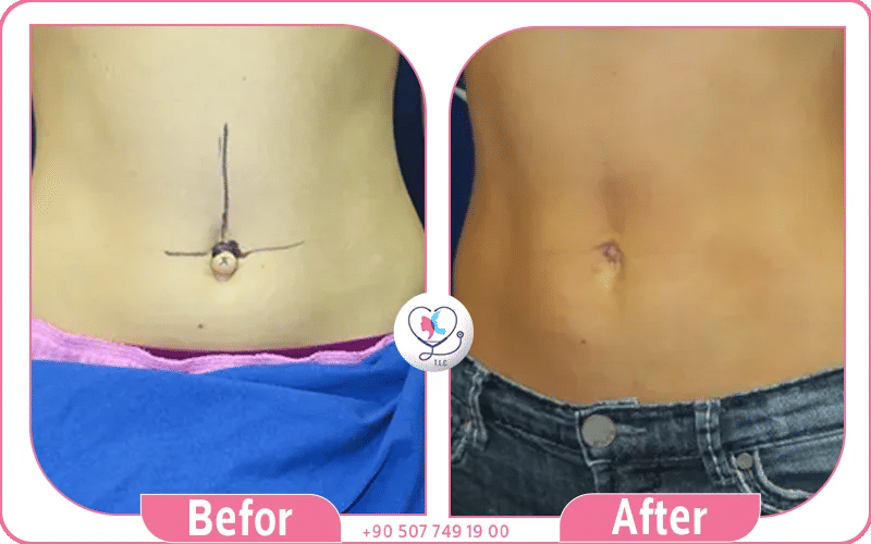 التعافي بعد عملية تجميل السرة التعافي بعد عملية تجميل السرة