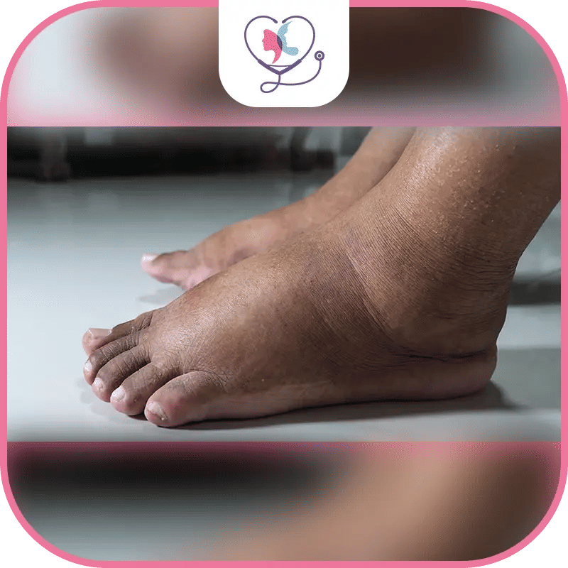 علاقة تورم الرجلين مع عملية شد البطن