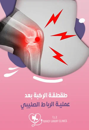 طقطقة الركبة بعد عملية الرباط الصليبي: الأسباب والوقاية
