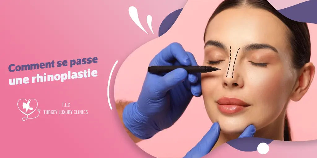 Comment se passe une rhinoplastie ?