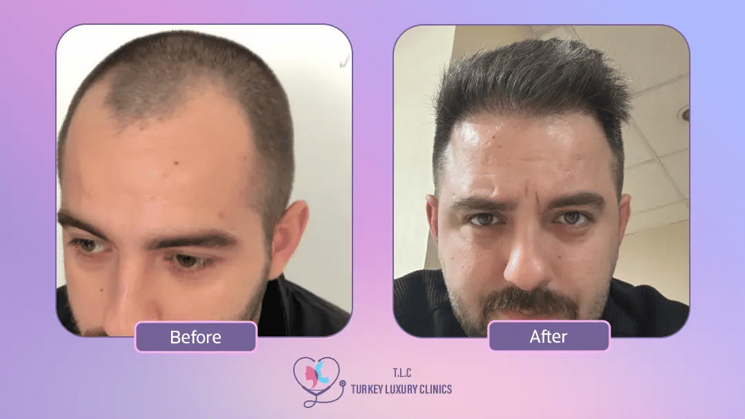 لماذا تختار تركيا لإجراء زراعة الشعر؟