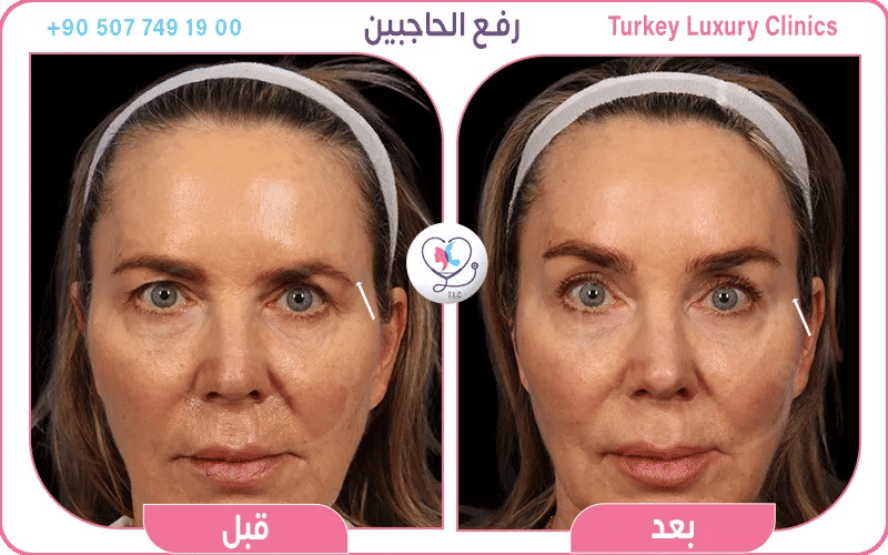 ما هي عملية رفع الحواجب؟