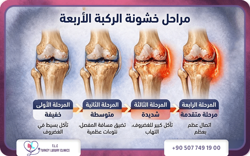 اعراض خشونة مفصل الركبة بحسب المراحل والدرجات