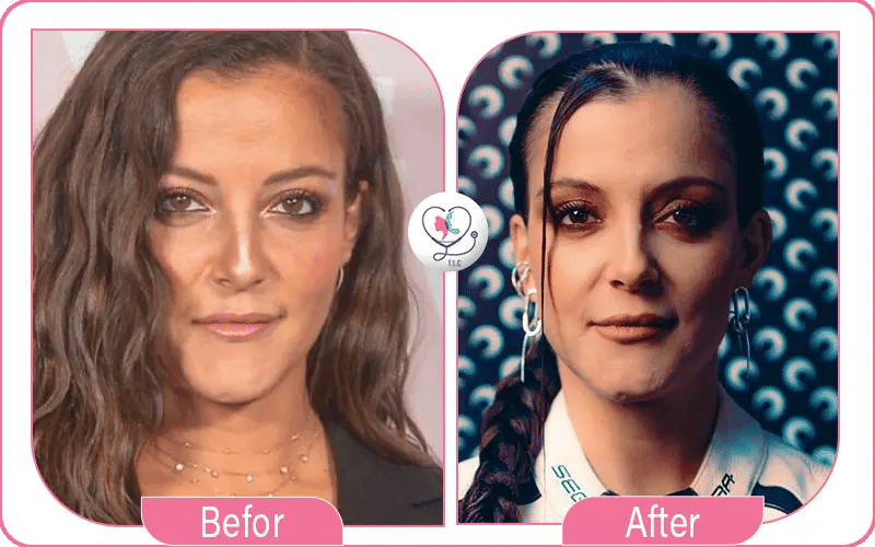 Camille Lellouche avant / après chirurgie-2