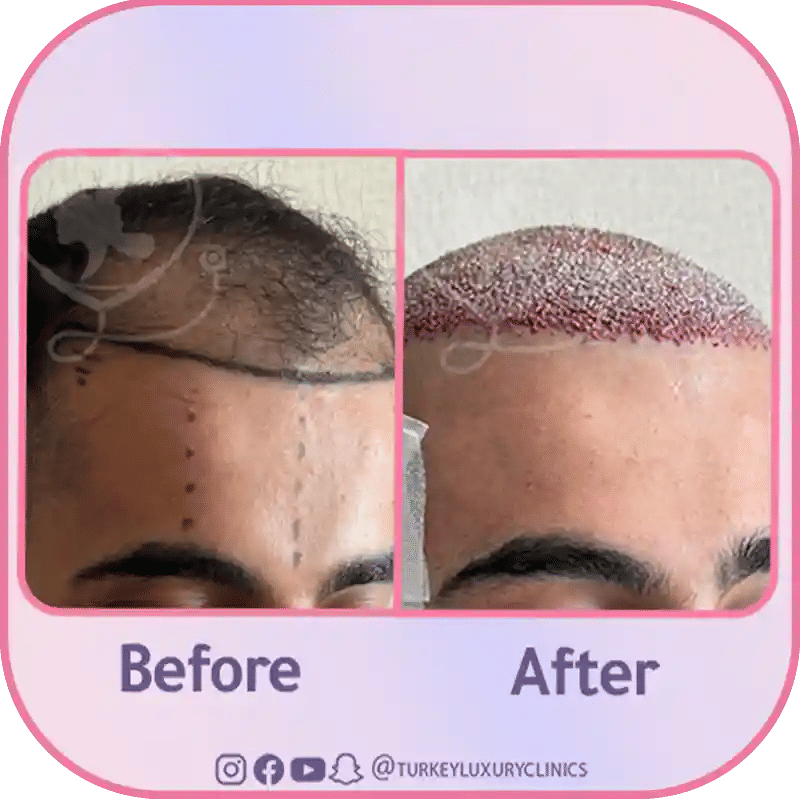 Recovery After Hair Transplant for Thinning Hair