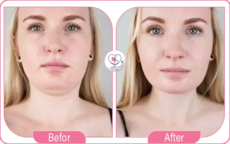 Photos avant / après chirurgie esthétique double menton-2