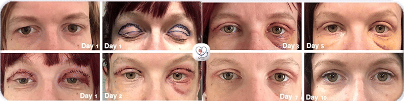 Blépharoplastie après 2 jours, 3 jours, 5 jours, 7 jours, 10 jours-1772045982892