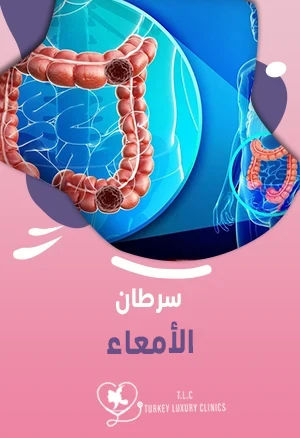 سرطان الأمعاء: الأعراض وطرق العلاج الفعالة والتكلفة