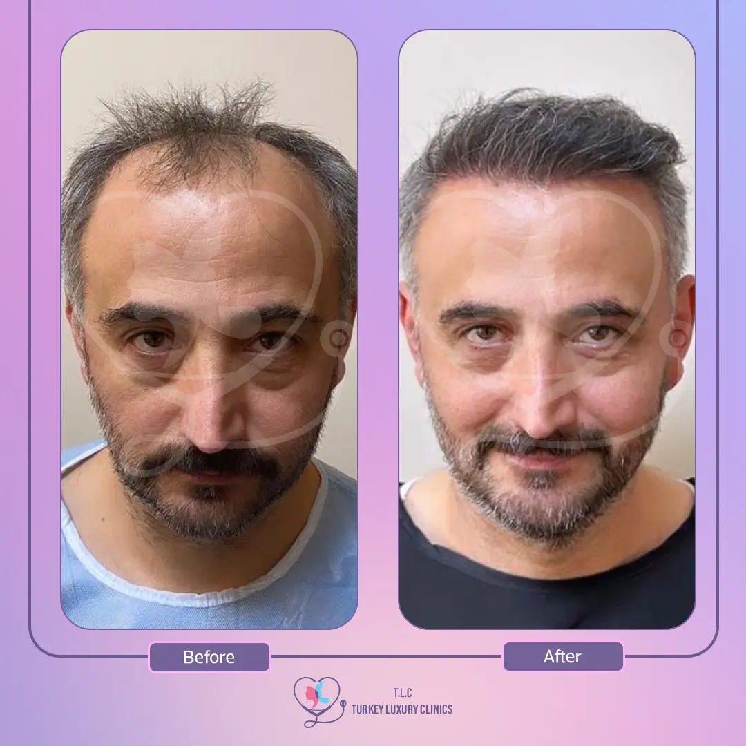 ثالثاً: زراعة الشعر