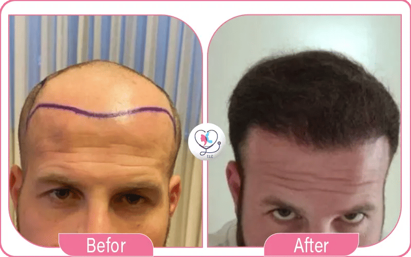 avis-et-témoignages-sur-la-greffe-de-cheveux-en-turquie-3