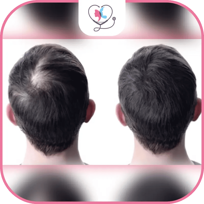 مميزات استخدام فيلر الشعر 