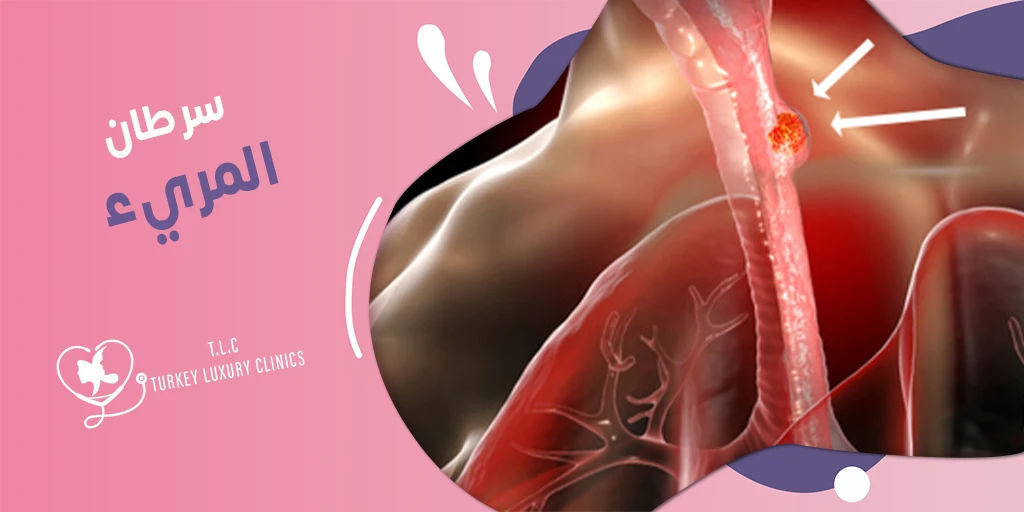 سرطان المريء: كيف ينشأ وما هي أنواعه وطرق العلاج؟