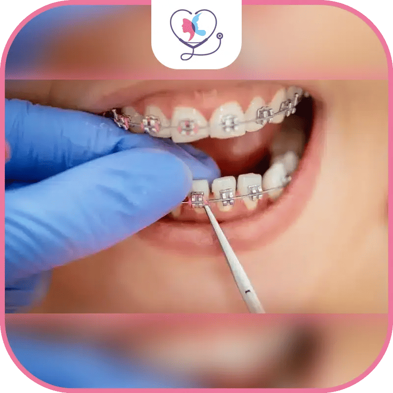 العوامل المؤثرة على سعر تقويم الأسنان في تركيا