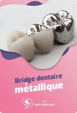 Bridge dentaire métallique : indications et avantages
