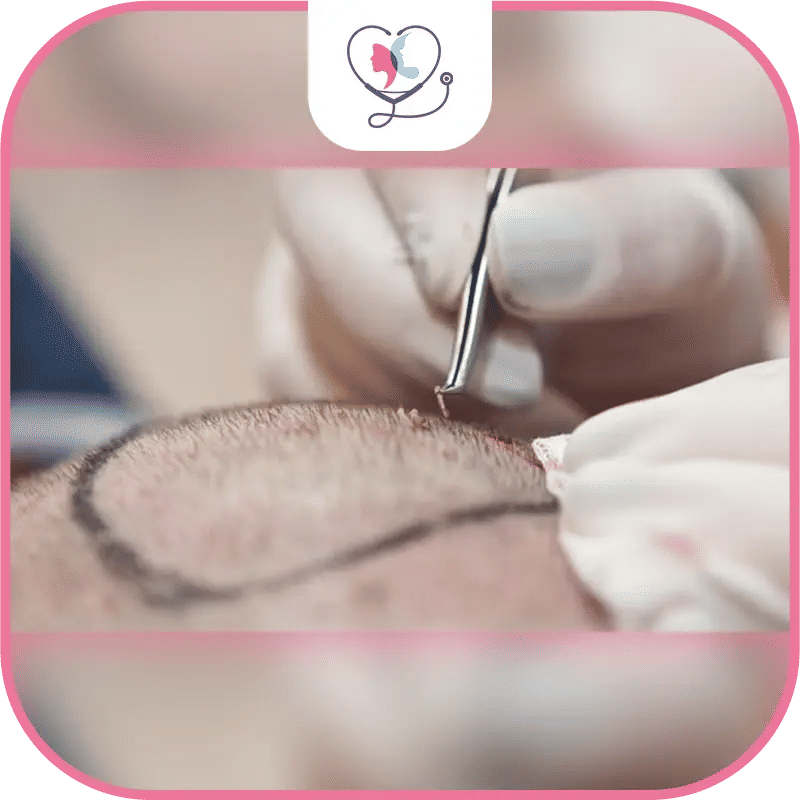 Scar Concealment Options After Hair Transplant