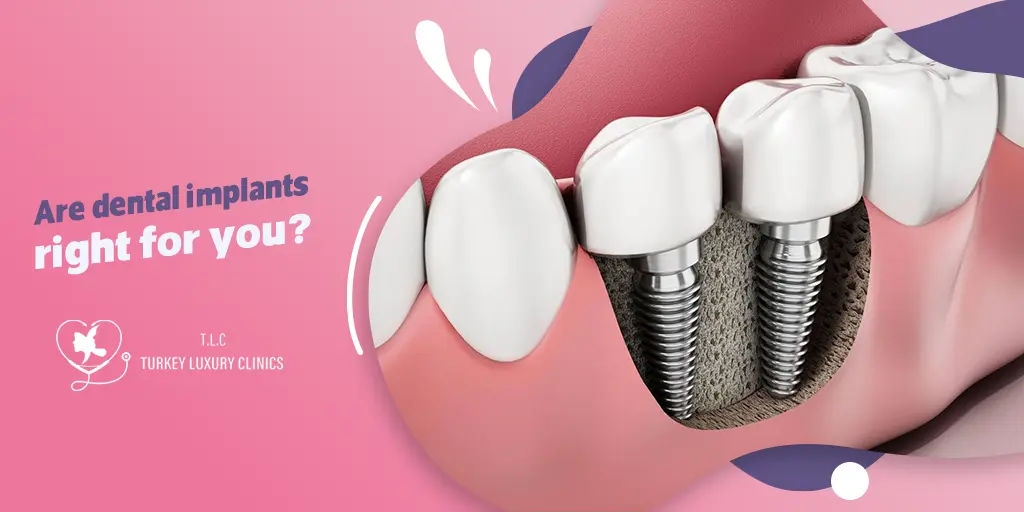 Are dental implants right for you? Understanding the benefits and considerations