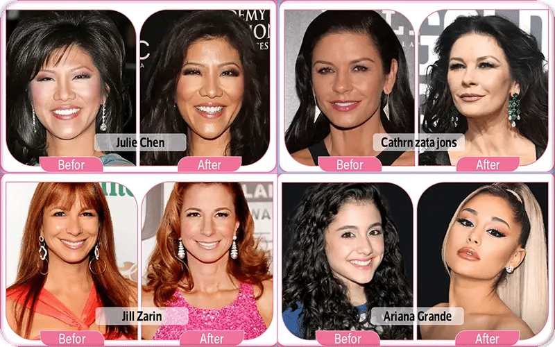 Hooded Eyes Celebrity Blepharoplasty Before and After