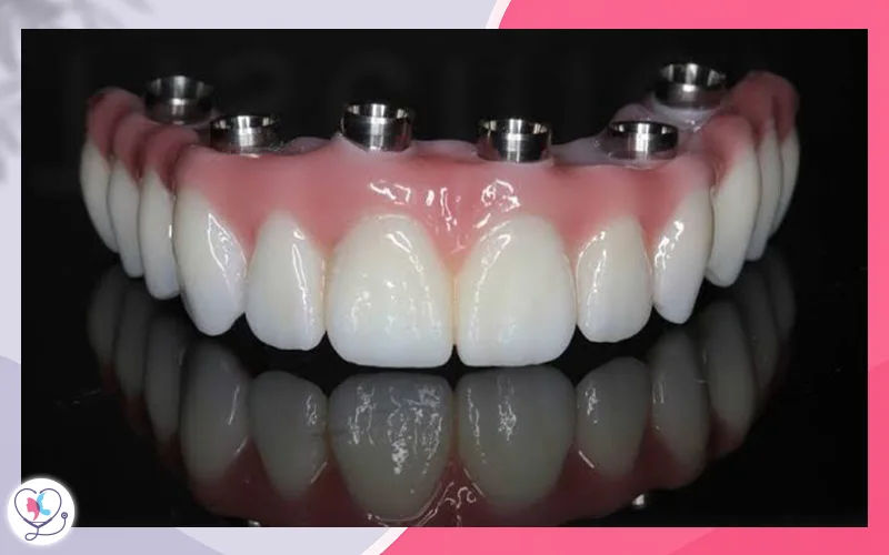 Full-Mouth Dental Implants