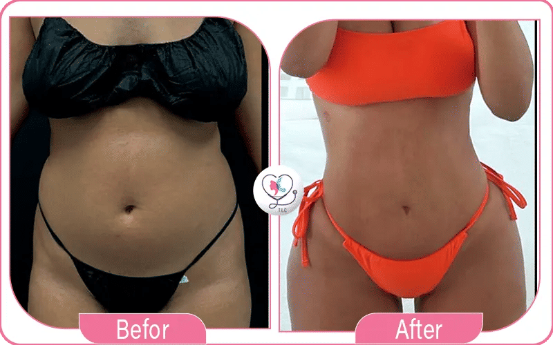 ما هي تكلفة شفط الدهون في مختلف الدول؟