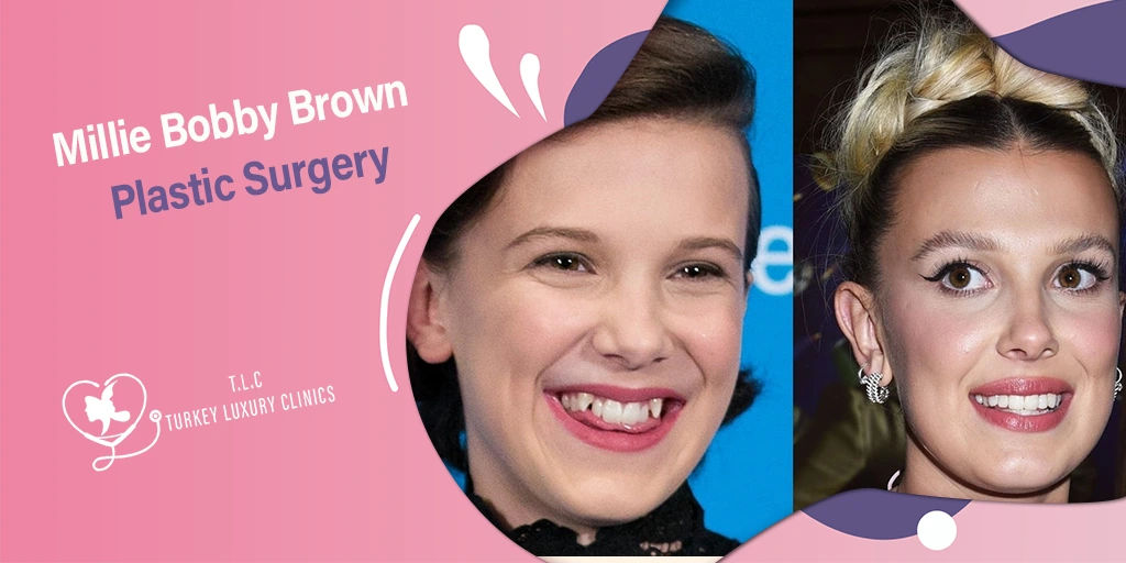 Chirurgia Estetica Millie Bobby Brown: Realtà e Rumors