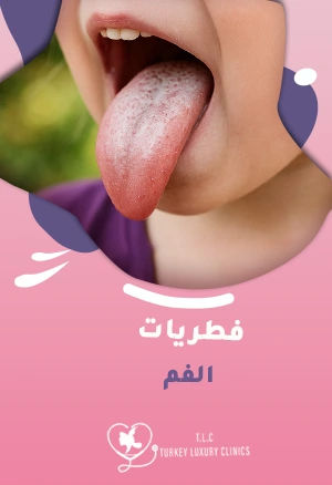 فطريات الفم: الأسباب، الأعراض وطرق فعالة لعلاجها بسرعة