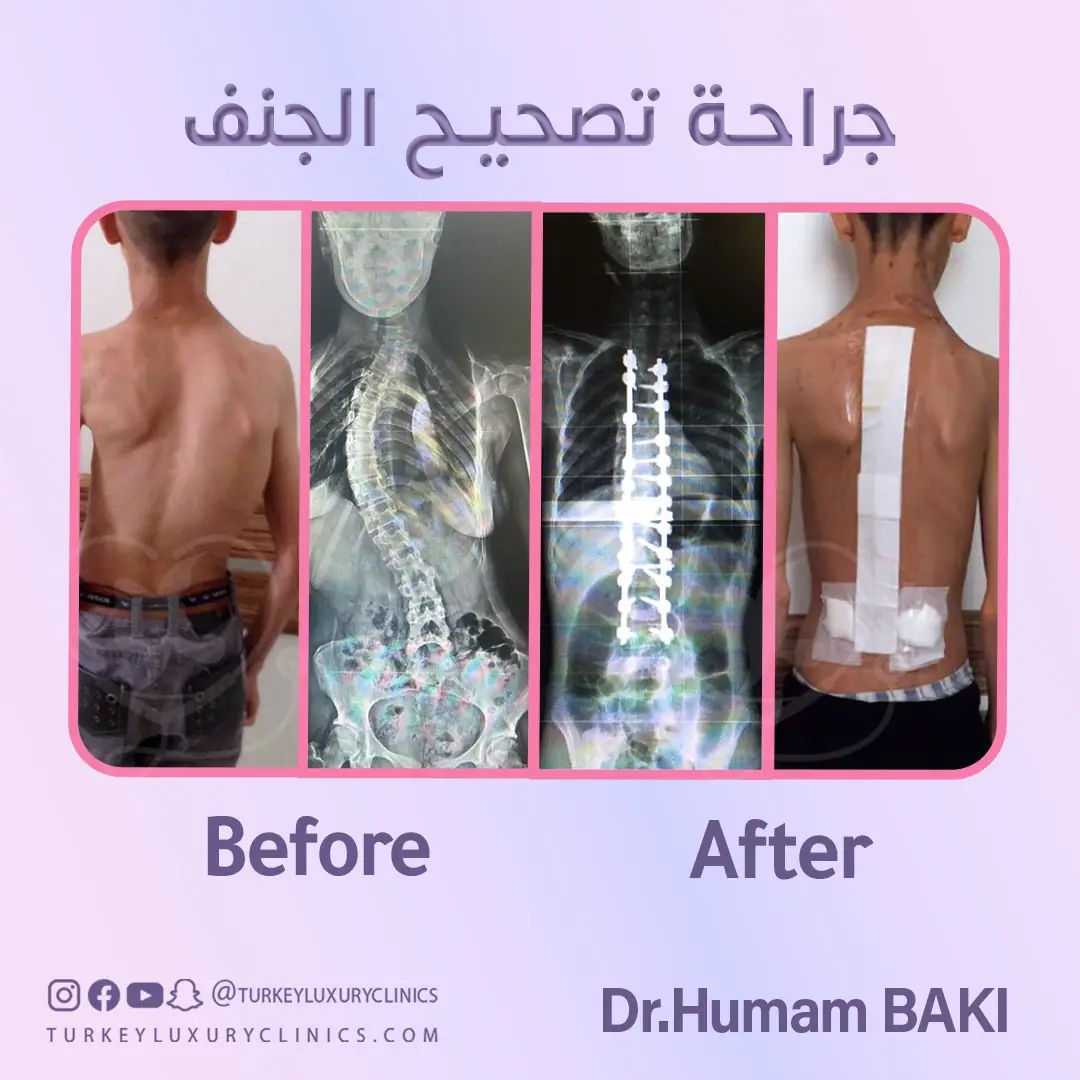 صور قبل وبعد جراحة الجنف في تركيا تحت أيدِ الطبيب همام باقي الغني عن التعريف: