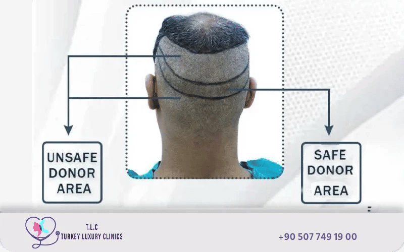 Diagram illustrating the scalp donor area at the back and sides of the head for hair transplant