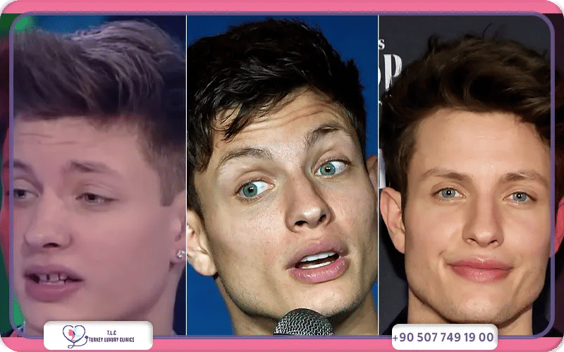 Matt Rife Plastic Surgery Photos Explained
