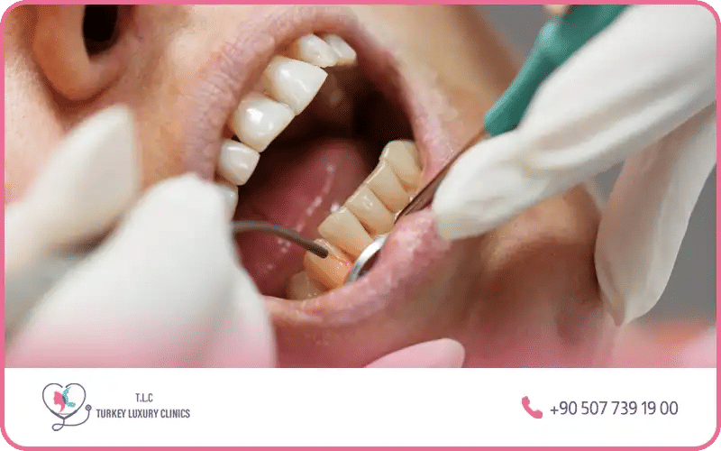 علاج جير الأسنان عند الطبيب