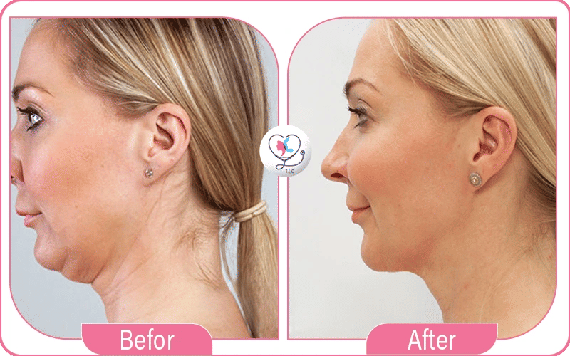 صور شد اللغلوغ بالخيوط قبل وبعد