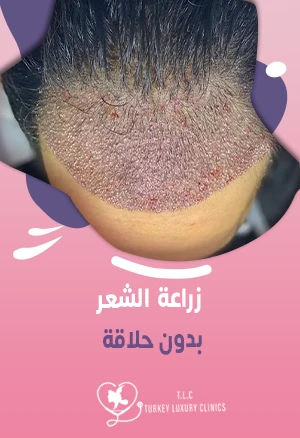 زراعة الشعر بدون حلاقة: هل يُمكن ذلك؟ اقرأ التفاصيل