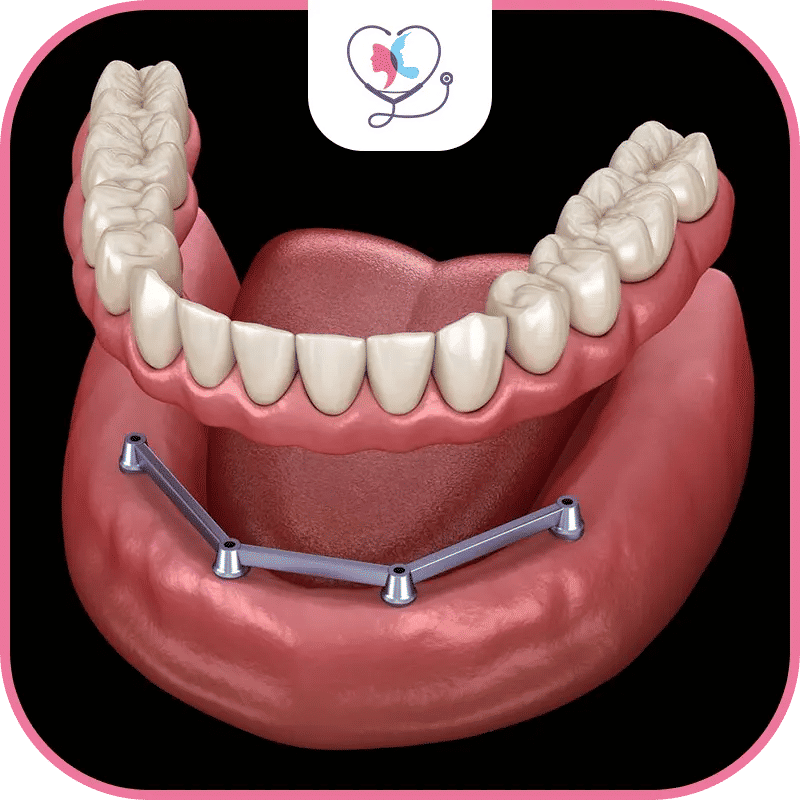 خطوات زراعة الأسنان All-on-4