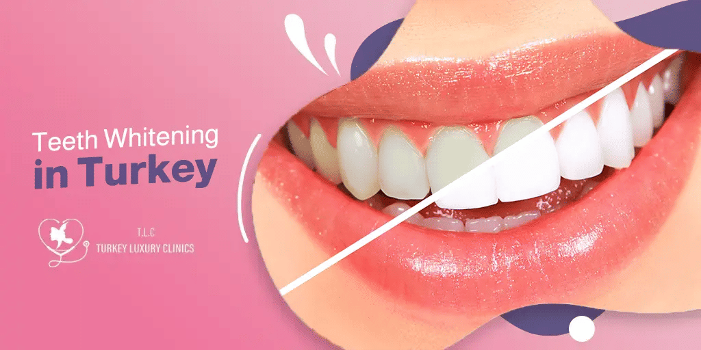 Teeth Whitening Turkey: Affordable Costs for a Brighter Smile 2026