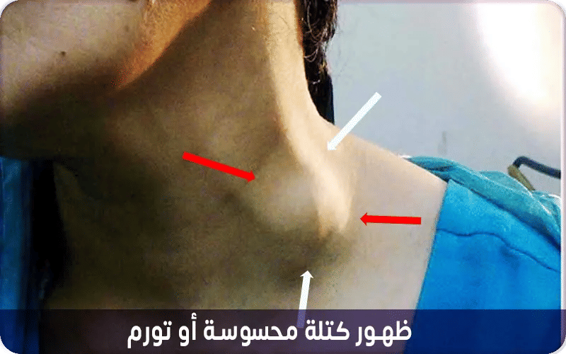 ظهور كتلة محسوسة أو تورم