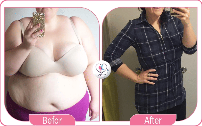 liposuccion ventre photo avant après