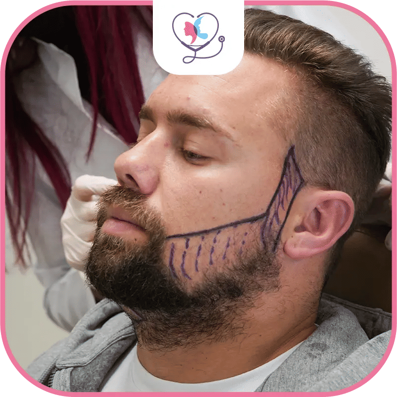 Beard and Mustache Transplant in Turkey