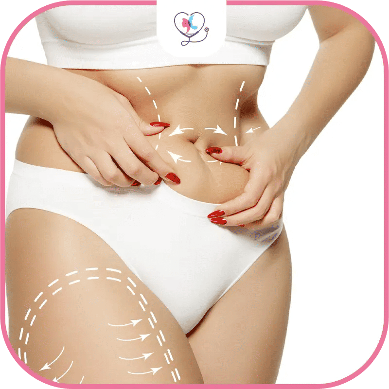 شفط الدهون في تركيا: دليلك الشامل