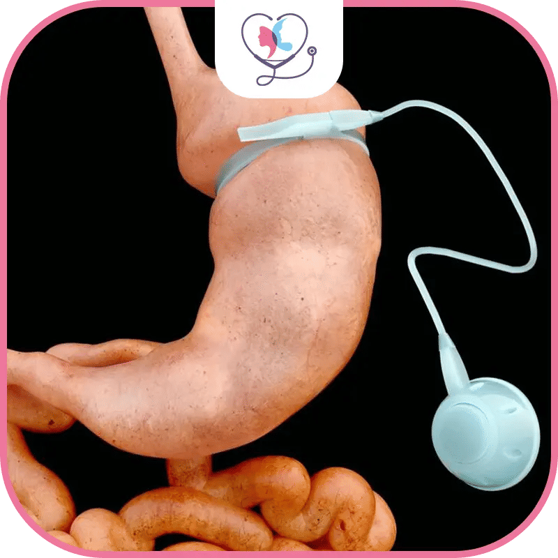 ما هي موانع عملية تكميم المعدة؟