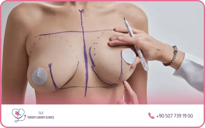 La principale opération est la mastopexie (