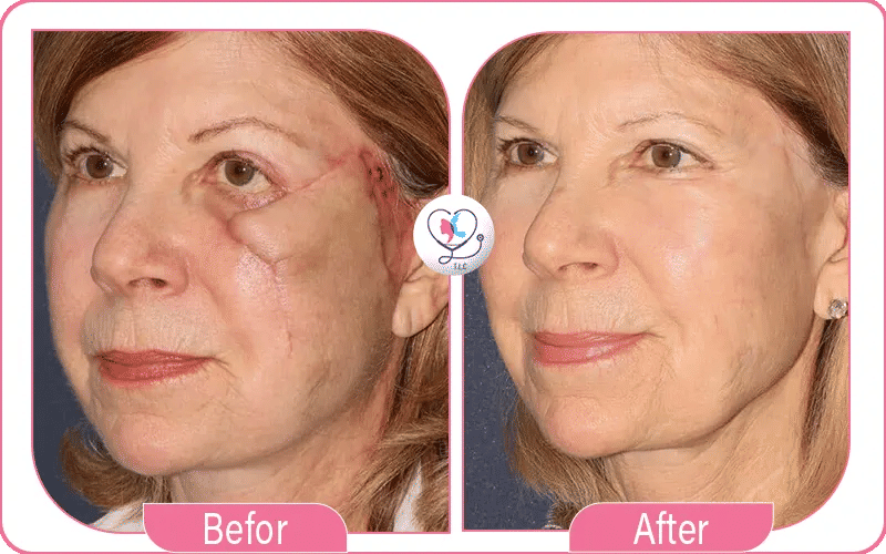 Résultats de la chirurgie reconstructrice