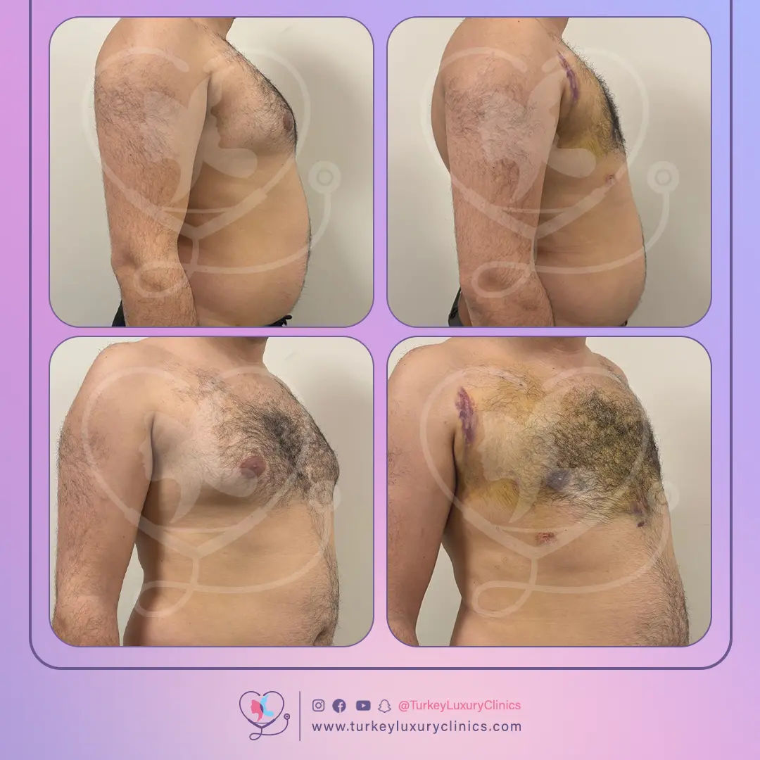 تكلفة عملية التثدي في تركيا 2025