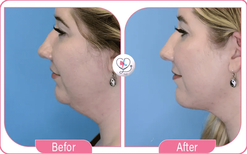 Mini Neck Lift Before and After Photos 3