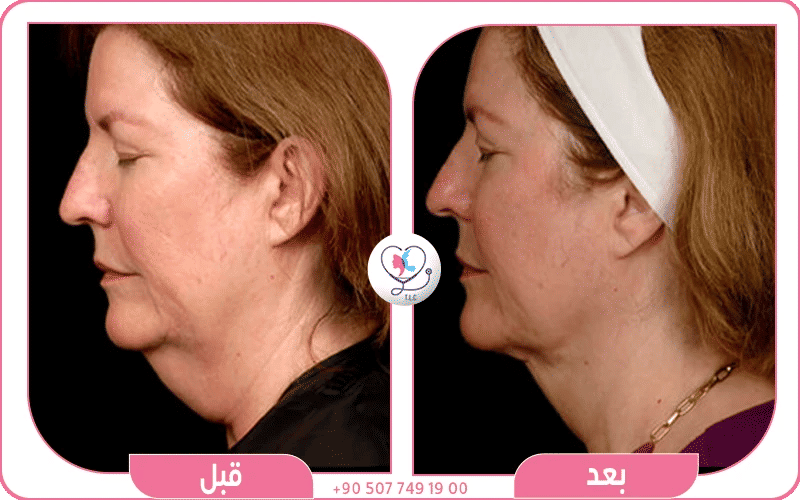 أنواع تقنيات شفط دهون الوجه