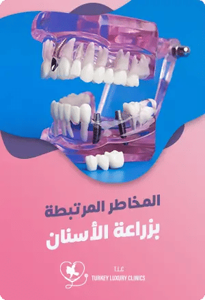 ماهي مخاطر زراعة الأسنان؟featured image