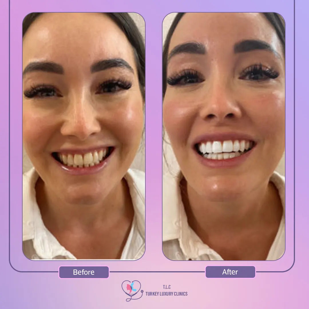 نتائج تبييض الأسنان بالصور قبل وبعد-2