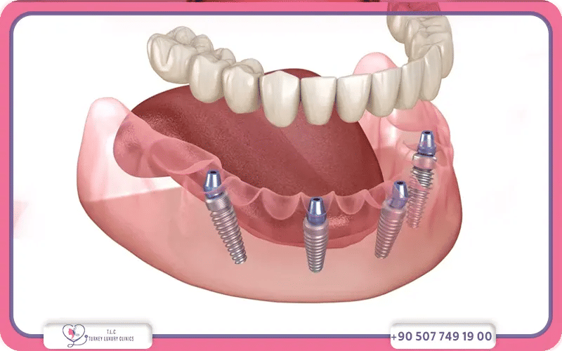 4 implant dentaire prix
