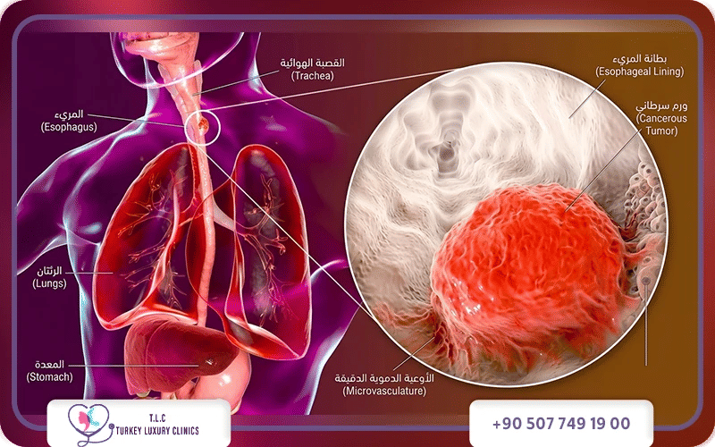 علامات سرطان المريء